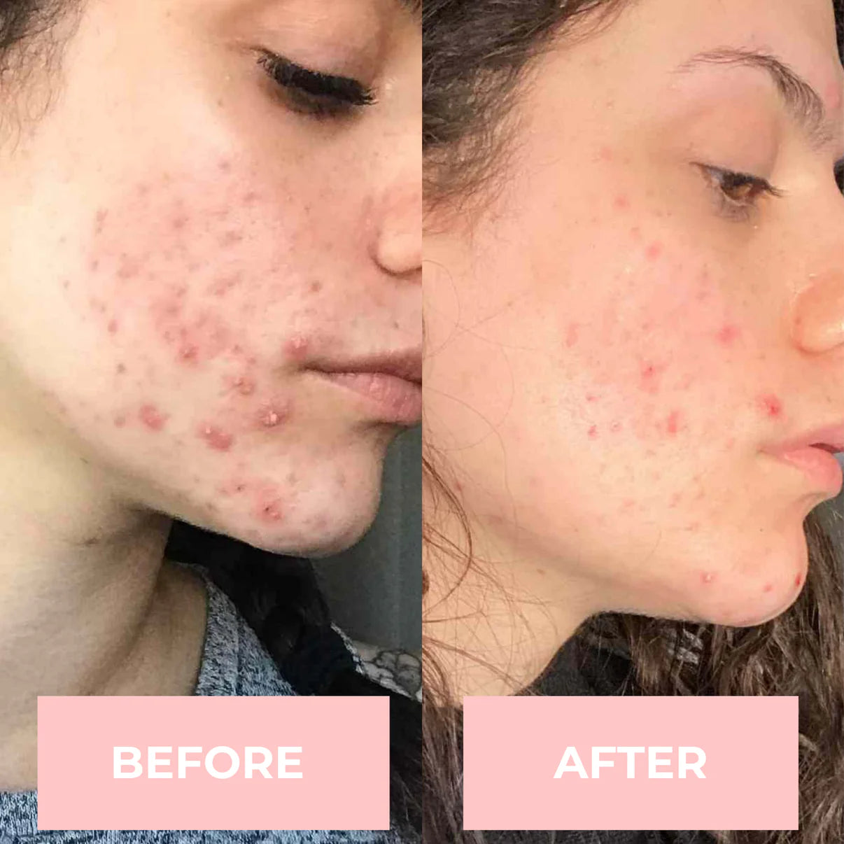 4-in-1 High Frequency Wand - Aurora Skin