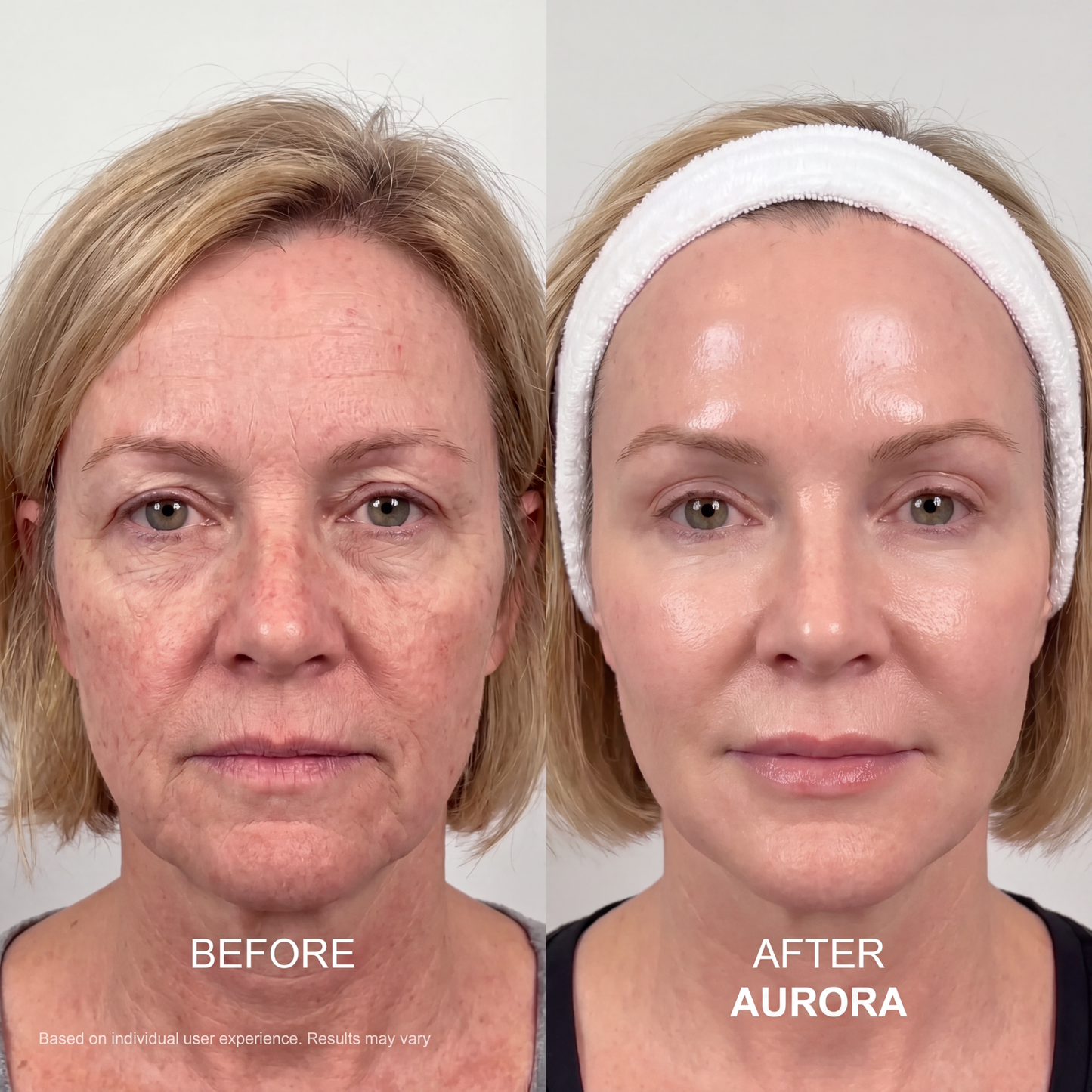 The Aurora System™ — At-Home Microinfusion