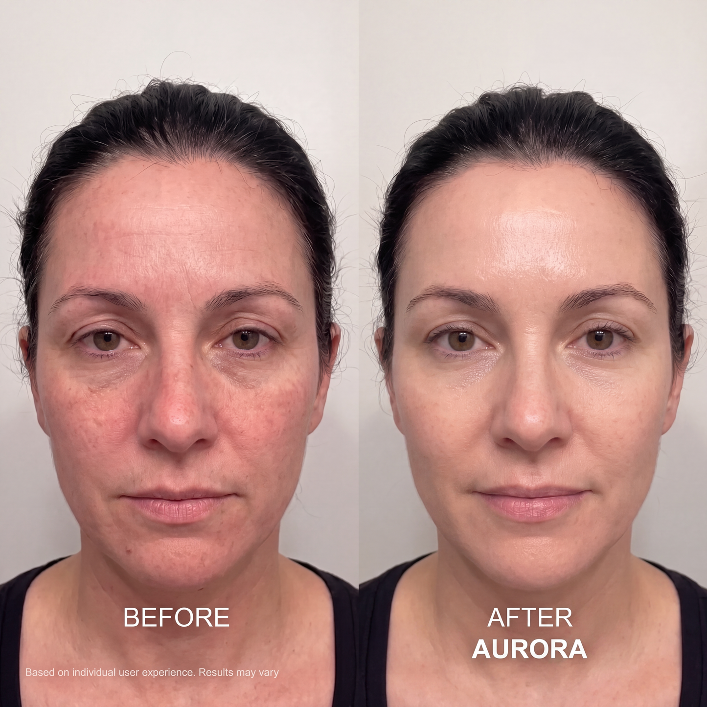 The Aurora System™ — At-Home Microinfusion