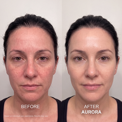 The Aurora System™ — At-Home Microinfusion
