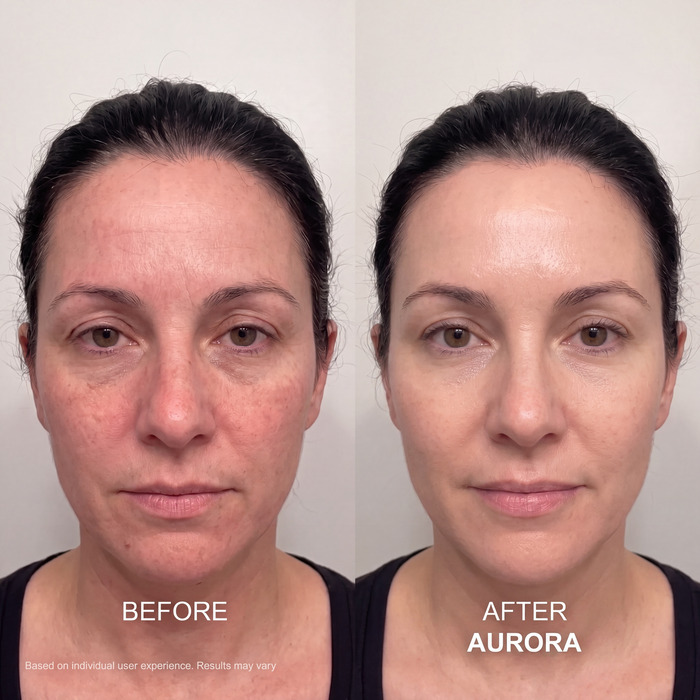 The Aurora System™ — At-Home Microinfusion