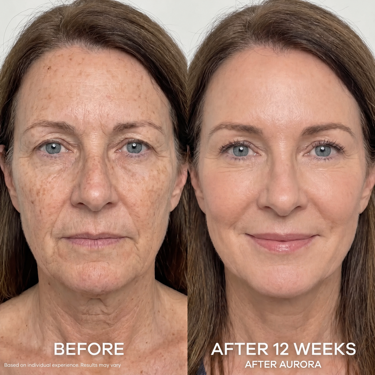 The Aurora System™ — At-Home Microinfusion
