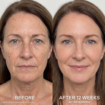 The Aurora System™ — At-Home Microinfusion