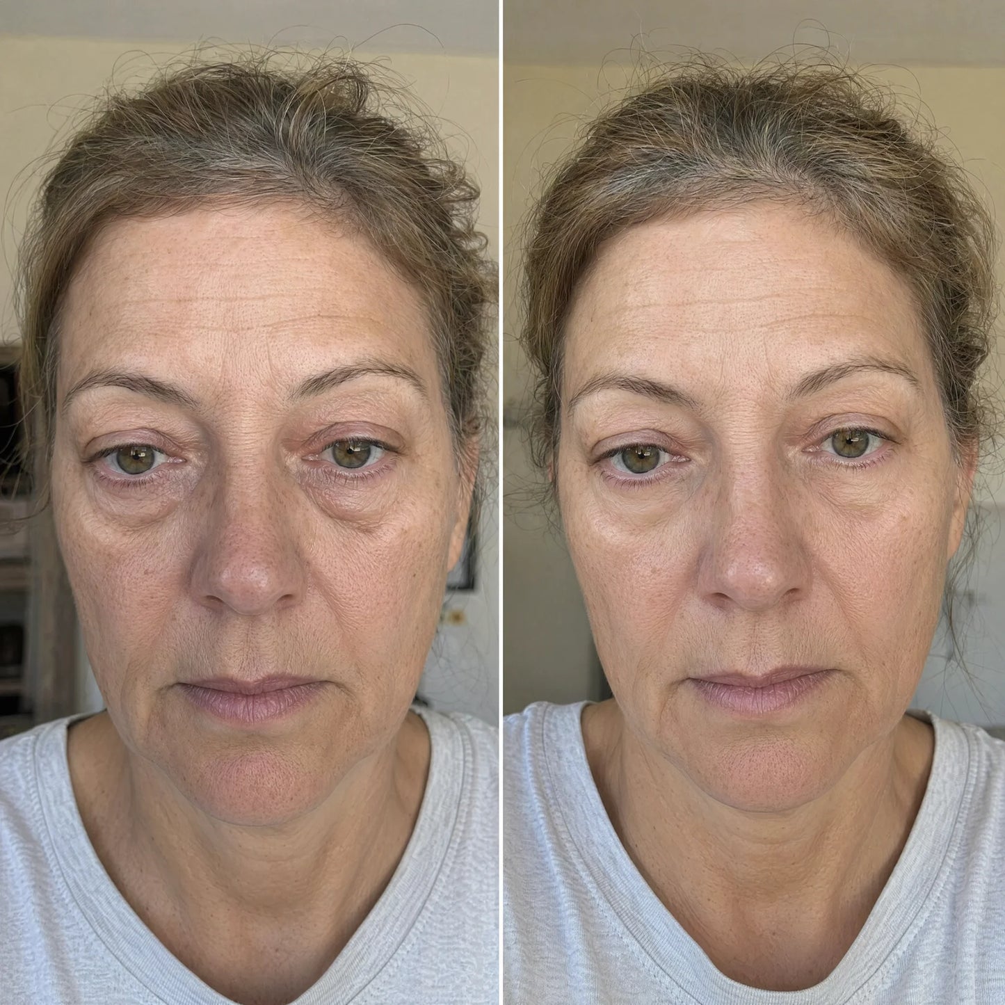 AuroraEyes™ Under Eye Red Light Therapy