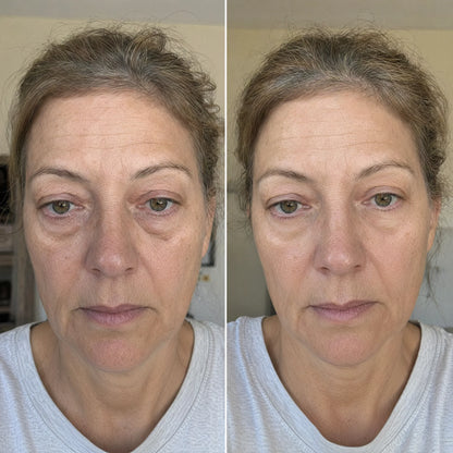 AuroraEyes™ Under Eye Red Light Therapy