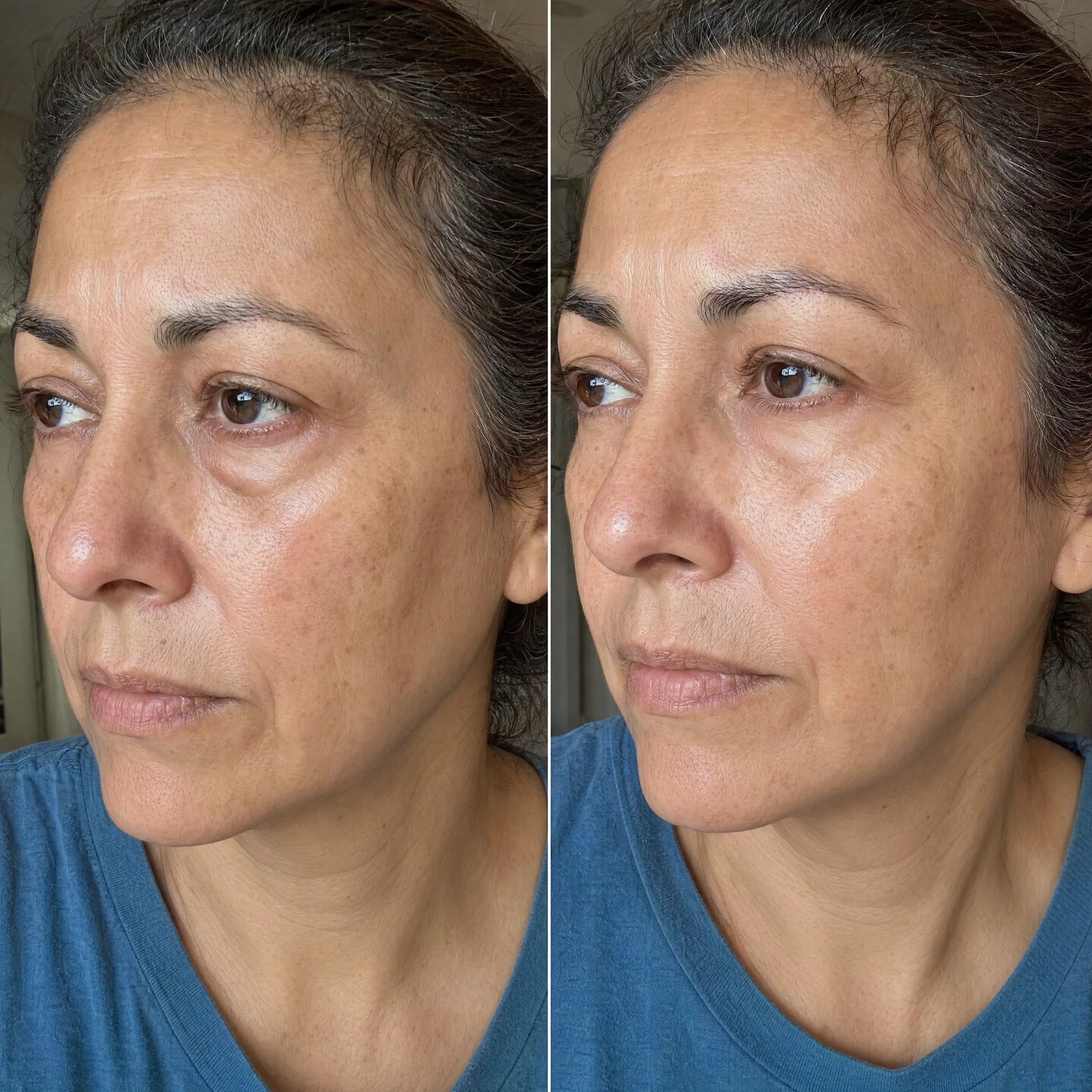 AuroraEyes™ Under Eye Red Light Therapy