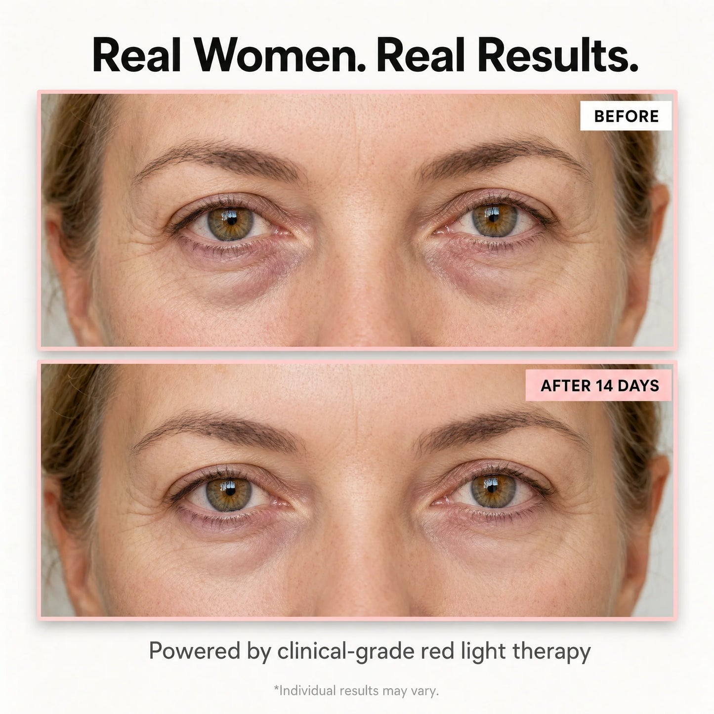 AuroraEyes™ Under Eye Red Light Therapy