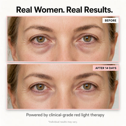 AuroraEyes™ Under Eye Red Light Therapy
