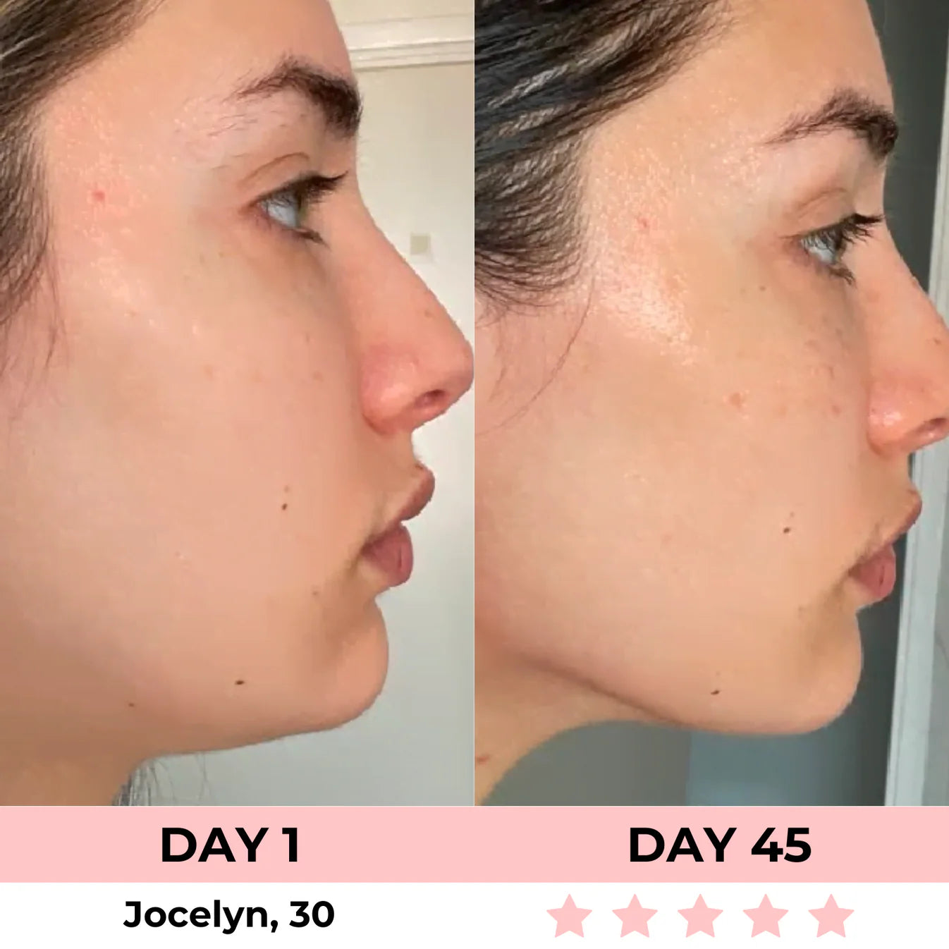 Before and after using LED facial sculptor for 45 days showing tightened jawline and improved skin tone